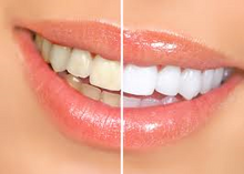 Load image into Gallery viewer, Miami Teeth Whitening
